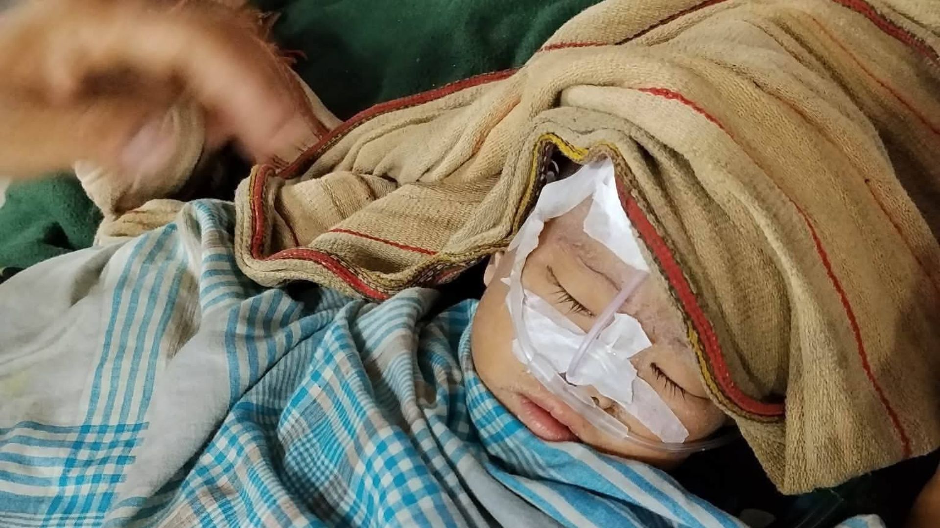 Measles outbreak in Bandarban's Alikadam: Another child dies, death toll now 7