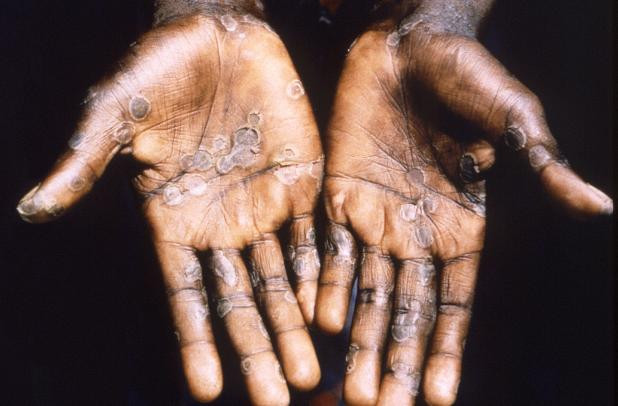 How prepared is Bangladesh to deal with monkeypox?