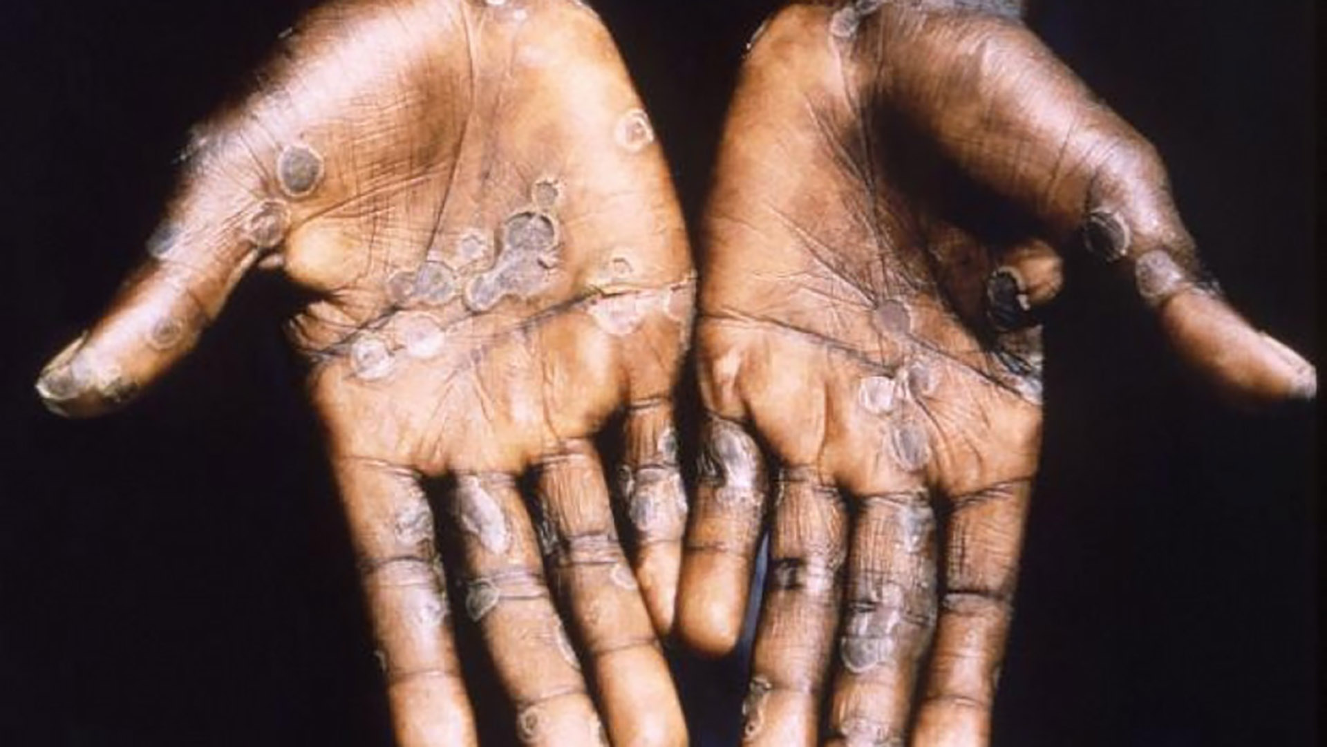 No monkeypox case detected in Bangladesh yet, BSMMU says