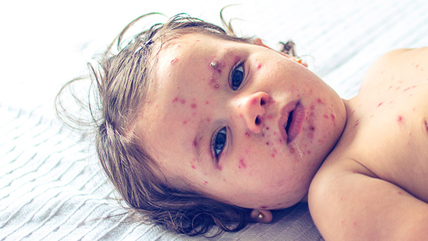 children suffering from measles during Eid