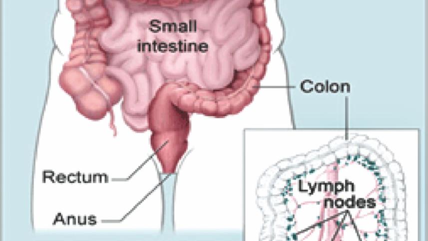 colon cancer
