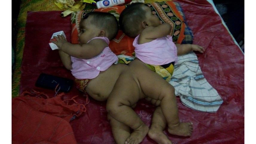 Conjoined-web.jpg