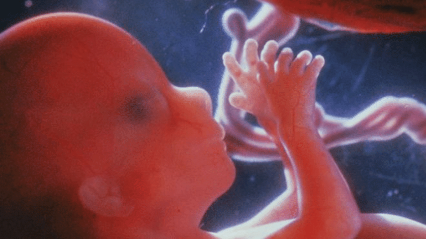 down's-syndrome-NWB.gif