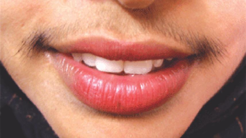 Hirsutism.jpg