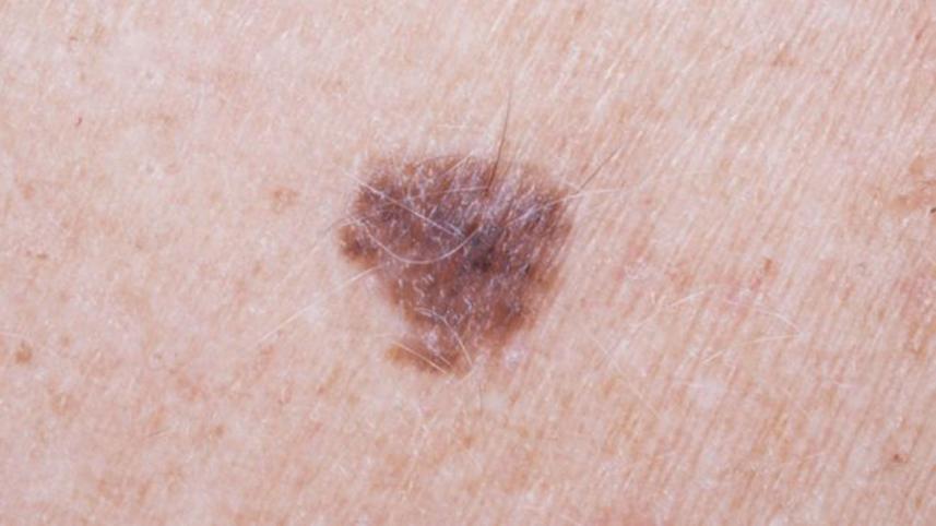 mole-cancer-wb.jpg