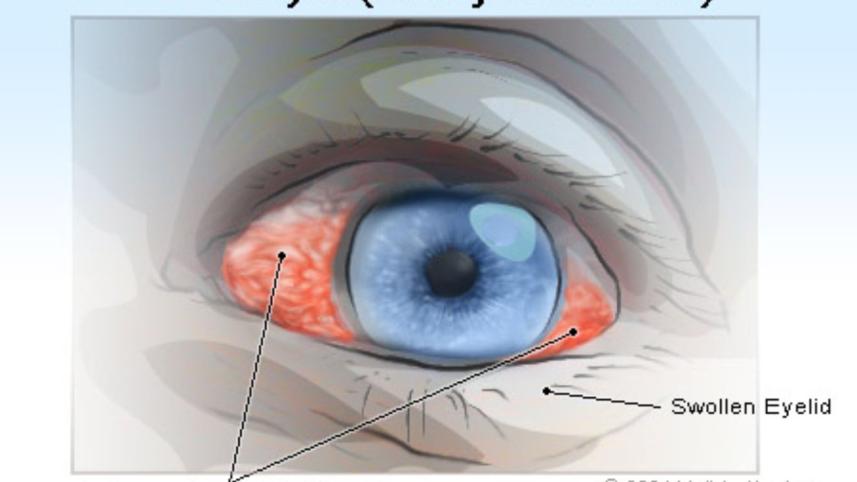 pink eye