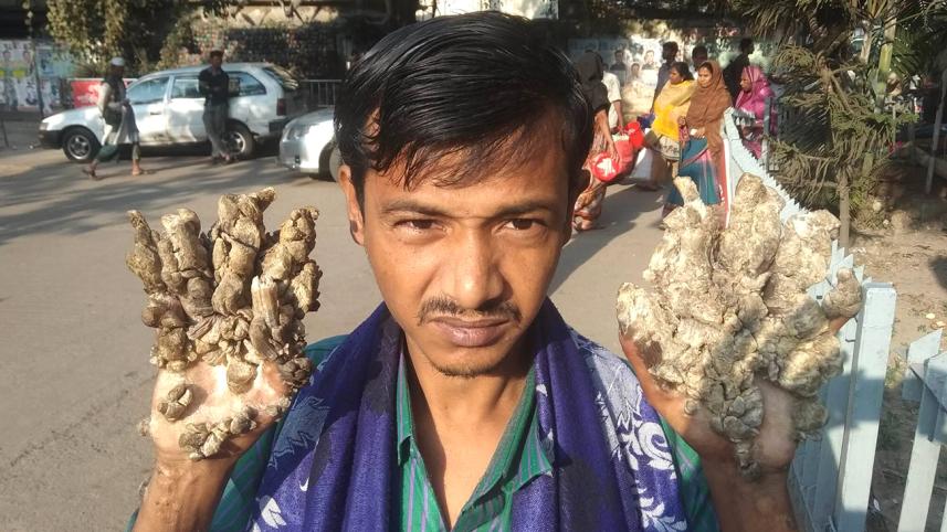 Bangladesh Tree-man