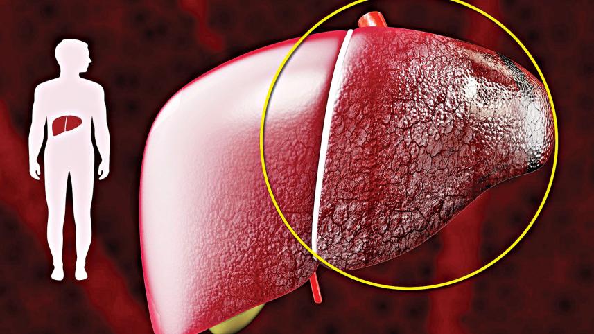 liver-cirrhosis.jpg