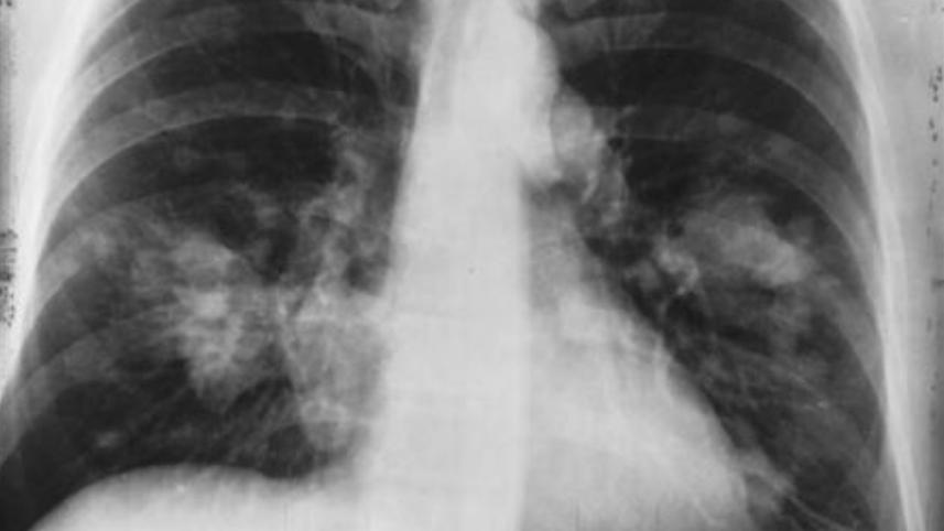 lung.jpg