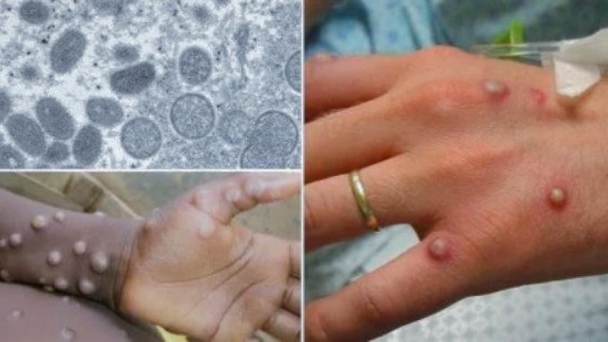 Monkeypox Virus
