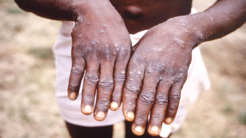 monkeypox.jpg