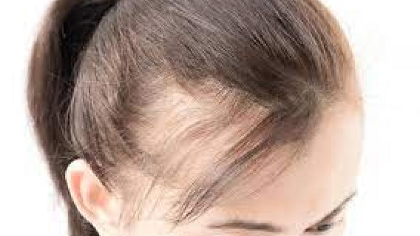Receding Hairline