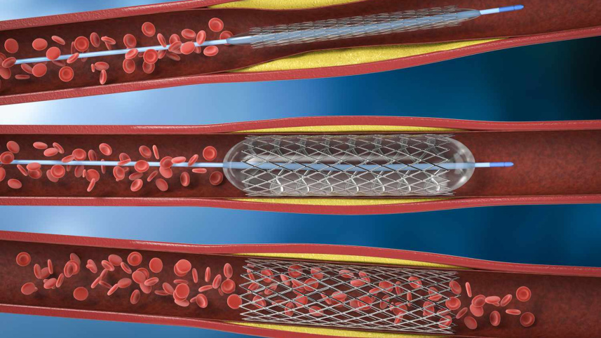 treating-blocked-arteries.jpg