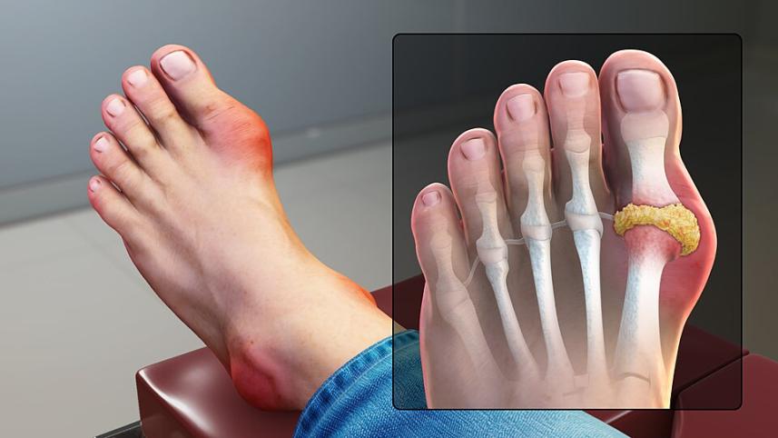 tips for gout patients eating red meat on eid