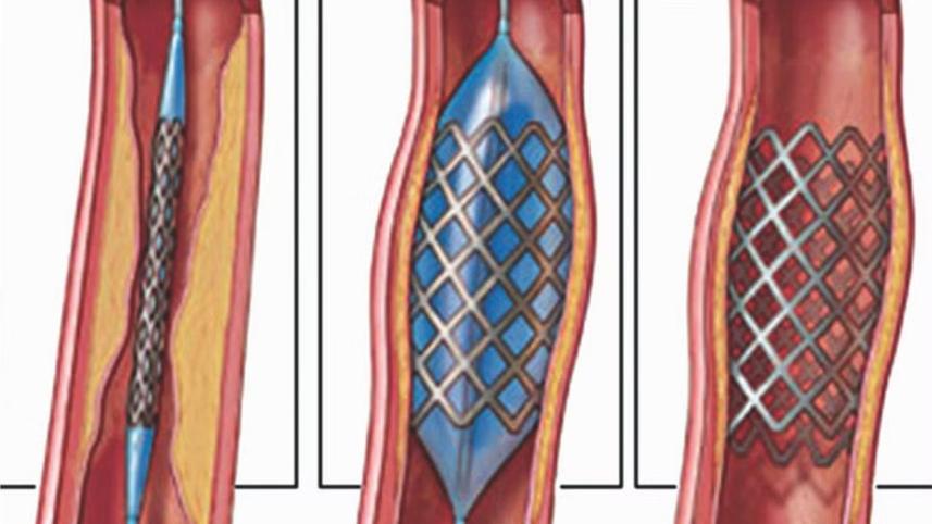 stenting.jpg