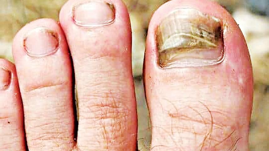 toe.jpg