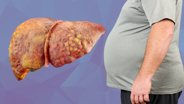 fatty-liver-disease.jpg