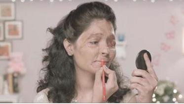 acid-victim-WEB.jpg