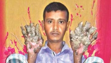 Bangladesh tree-man