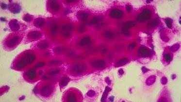 cancercells.jpg