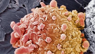 Melanoma 2.jpg