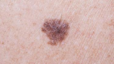 mole-cancer-wb.jpg