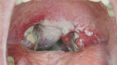 sore throat.jpg
