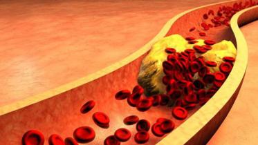 stents.jpg