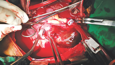 tumour.jpg