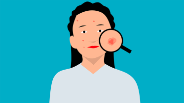 acne-web.png