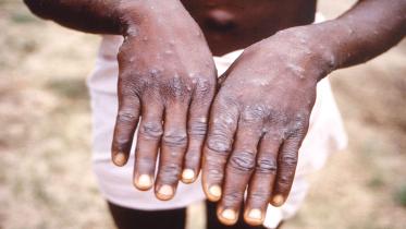monkeypox.jpg