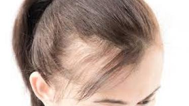 Receding Hairline