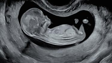 Foetus