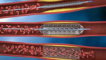 treating-blocked-arteries.jpg