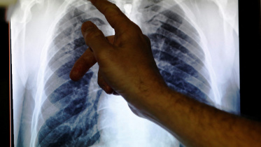 tuberculosis.jpg