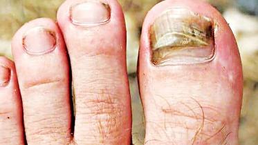 toe.jpg