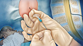 epidural-pain-relief-labour.jpg