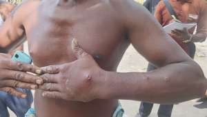 anthrax outbreak in Gaibandha 2026