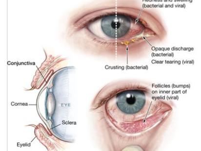 pink eye infection