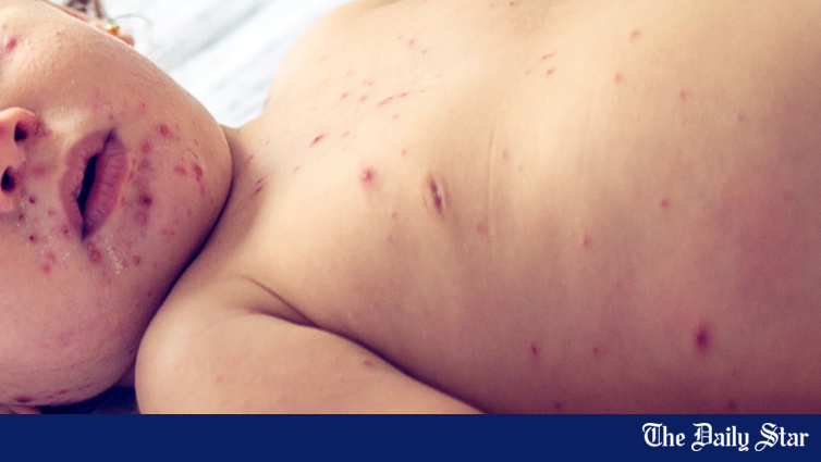 Photo: online92.thedailystar.net Bangladesh Measles Outbreak: Death Toll Surpasses 1,000 Children